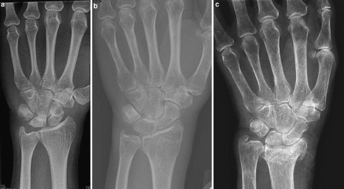 Radiography in Osteoporosis | SpringerLink