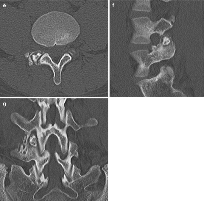 Overcoming CT-to-Body Divergence to Biopsy, Definitively Diagnose and Mark  a Subcentimeter Lesion