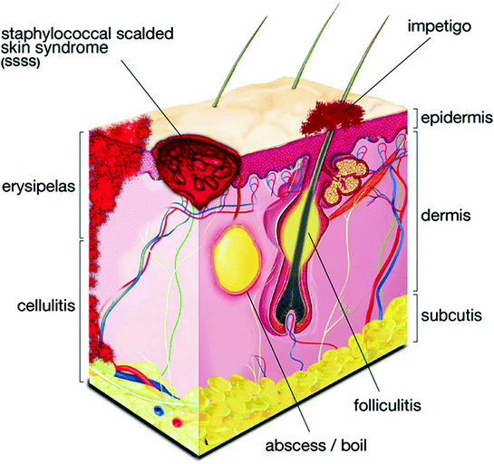 Skin Infections Caused by Staphylococcus aureus, HTML