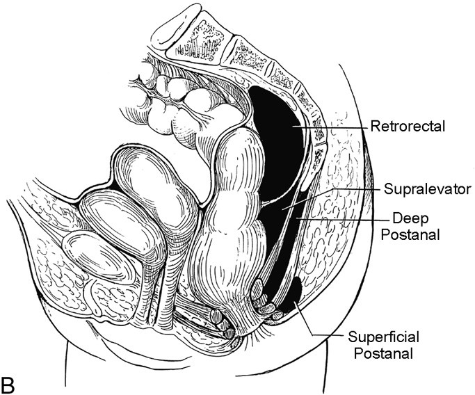 Benign Anorectal Abscess and Fistula SpringerLink