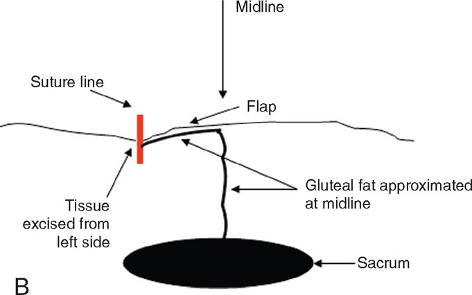 Excision of Extensive Recurrent Pilonidal Cyst with Gluteus Muscle Fascia  Plasty & Mid-line Closure 