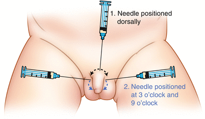 Needle Penis