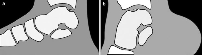 Posterior Ankle Arthroscopy and Endoscopy