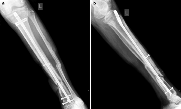 Patient with tibia nonunion. a X-ray from the pre-treatment period