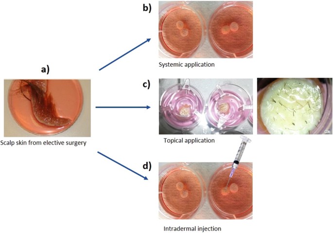 Methods to Study Human Hair Follicle Growth Ex Vivo: Human Microdissected  Hair Follicle and Human Full Thickness Skin Organ Culture | SpringerLink