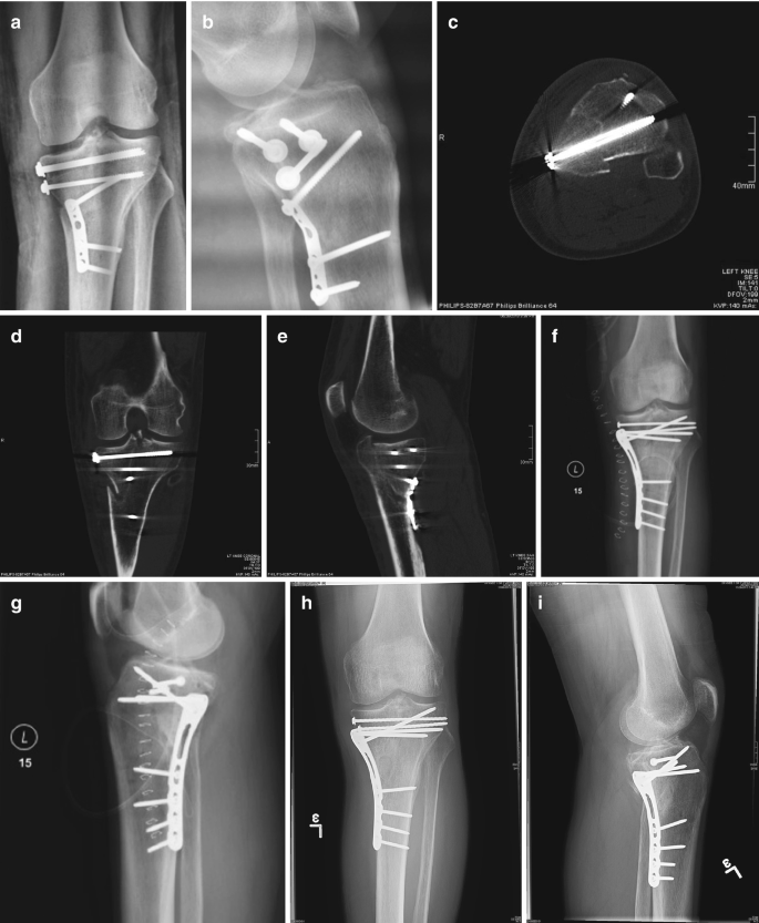 Malunited fracture - tibia, Radiology Case