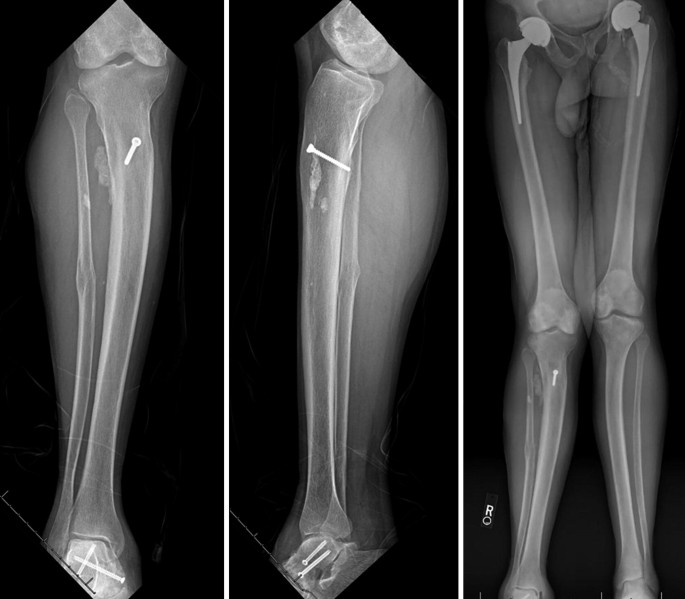 Malunited fracture - tibia, Radiology Case