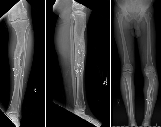 Malunited fracture - tibia, Radiology Case