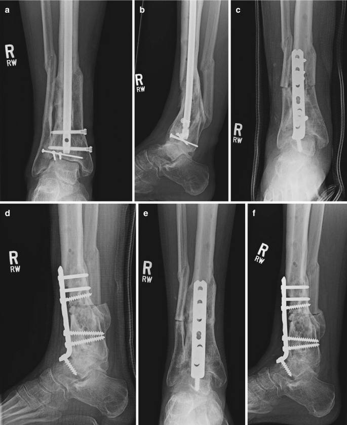 Malunited fracture - tibia, Radiology Case