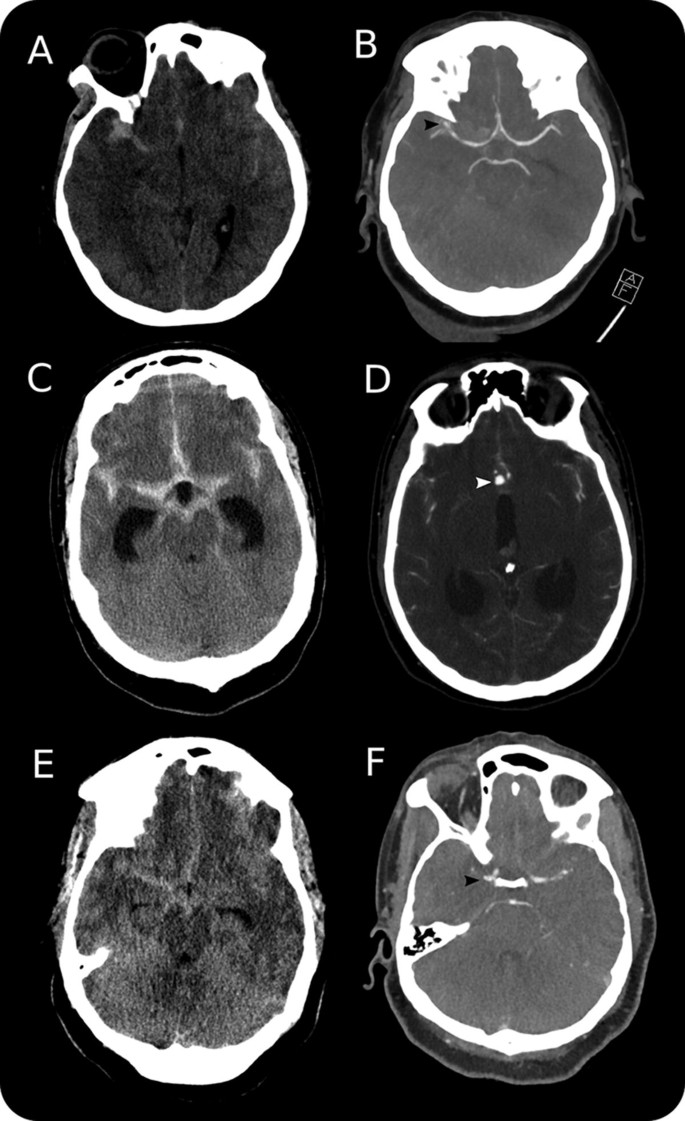 Imaging Evaluation of SAH and Aneurysm