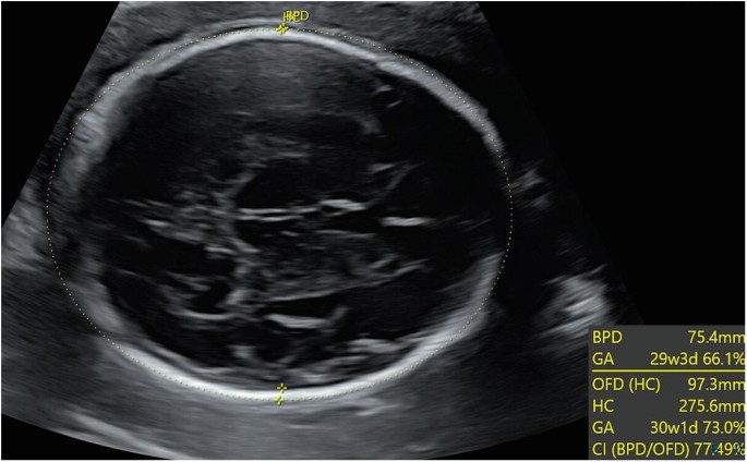 Antenatal Ultrasound Imaging for Analysis of Human Craniosynostosis |  SpringerLink
