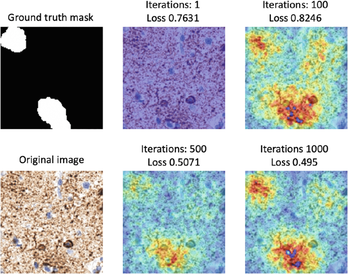 Six histology images. The images on the top are labeled ground truth mask, iterations 1, loss 0.7631, iterations 100, loss 0.8246. The images on the bottom are labeled original image, iterations, 500, loss 0.5071, and iterations 1000, loss 0.495, from left to right, respectively.