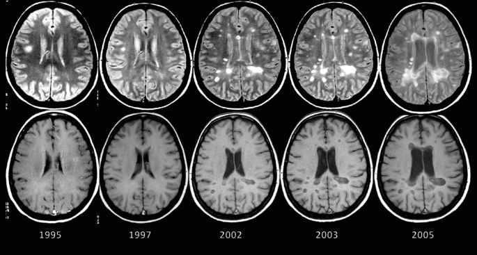 A set of 10 M R images of the brain, in 2 sets, of years 1995, 1997, 2002, 2003, and 2005. Above, the bright region begins to appear in 2002 and grows over time. Below, the central dark region enlarges over the years.