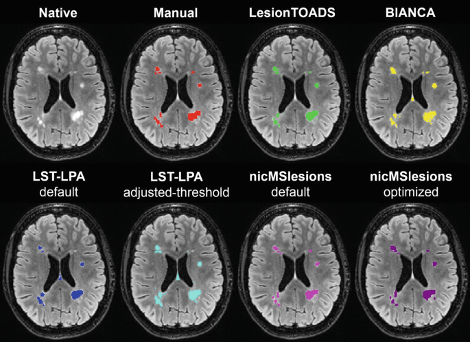 Eight F L A I R images of the brain. The images depict colored spots around the 4 corners of the central region for native, manual, lesion T O A D S, B I A N C A, L S T-L P A default and adjusted, and n i c M S lesions default and optimized.