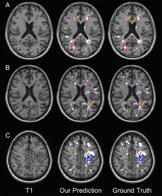 Three sets of 3 M R images. The central dark region is in sets A and B and not in C. Colored spots for myelin changes surround the central region in the same pattern in prediction and ground truth images of each set.
