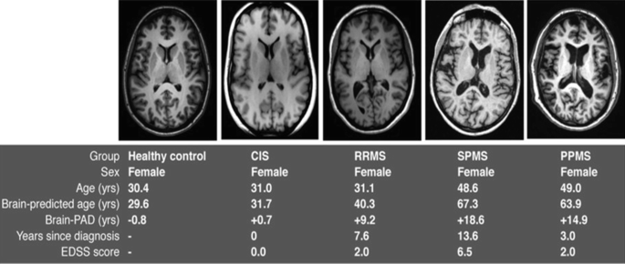 Five M R images of groups healthy control, C I S, R R M S, S P M S, and P P M S with details. All images have almost similar patterns. The difference between age and brain-predicted age increases from healthy to P P M S.