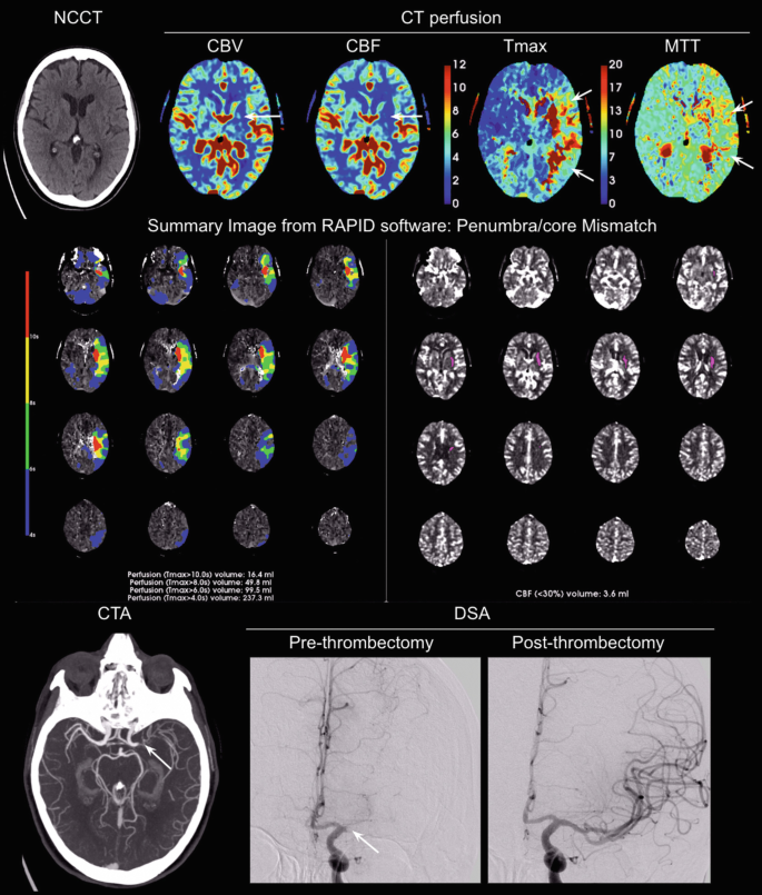 A C T scan depicts the conditions that occur in a stroke. The summary photos depict the change. In post-thrombectomy, the nerves are scattered.