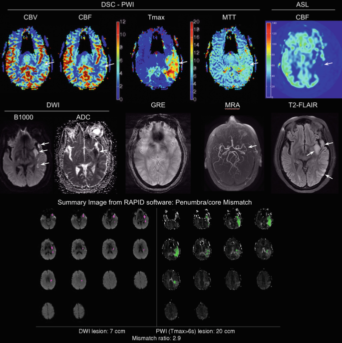 An M R I scan depicts the change that occurs in acute stroke. The C B V, C B F, M R A conditions are displayed.