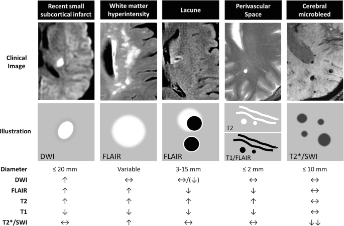 Five clinical photos and illustration with the diameter of recent small subcortical infract, white matter hyperintensity, lacune, perivascular space, and cerebral microbleed is depicted.