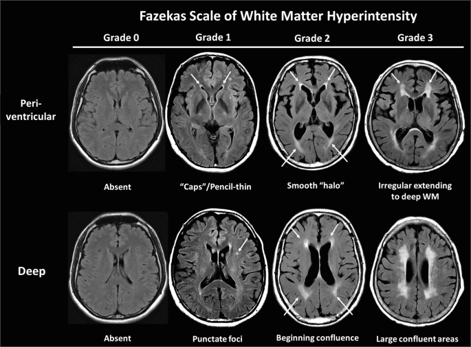 A series of C T scans depict Fazekas scale of white matter hyperintensity of peri ventricular and deep with different 4 grades, 0, 1, 2, and 3.