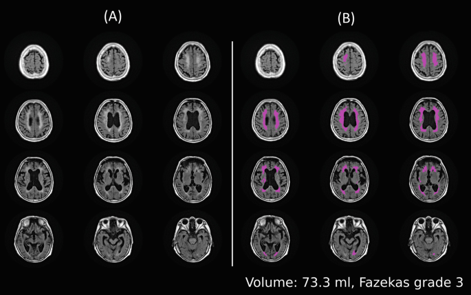 A series of C T scans represents the white matter hyperintensity in the brain in different cases. Scans are labeled below: Volume 73.3 ml, Fazekas Grade 3.