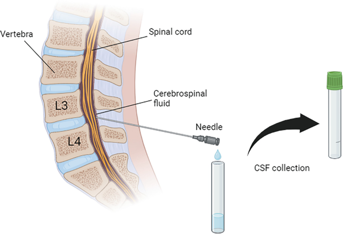 Label Collection Csf Luminex Multiplex Immunoassay for Proteomic Profiling of Cerebrospinal ...
