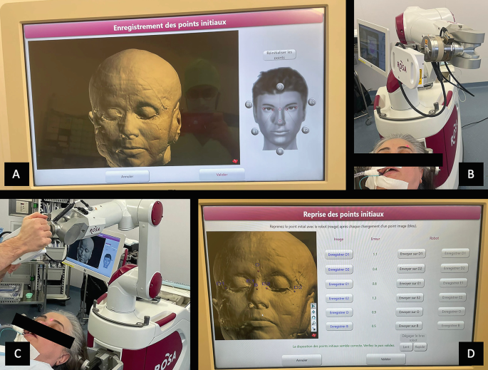 Stereotactic Brain Biopsy Technique with Robotic Assistance | Springer ...