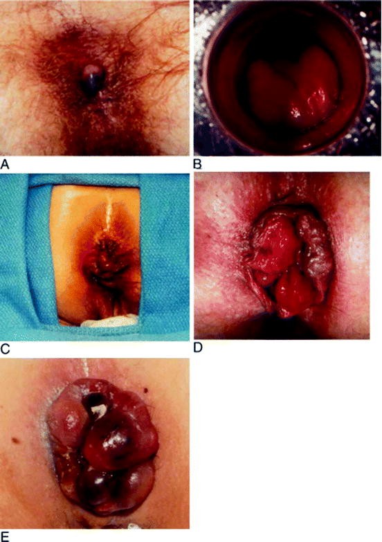 Bleeding Hemorrhoids | SpringerLink