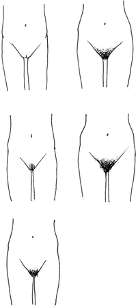pubic hair stage 2. Please LOOK at the drawings and read the sentences below each of them.  Then choose the drawing closest to your stage of pubic