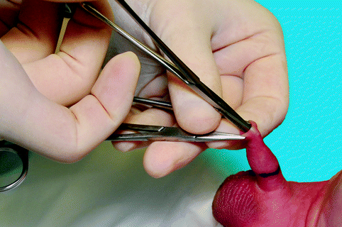 Circumsure ESR Circumcision Stapler at Rs 5000/piece | Sector 66 | Gurugram  | ID: 2852138813162