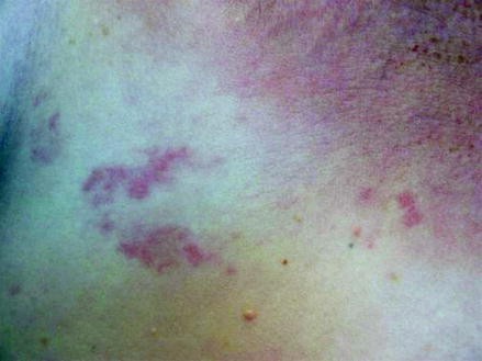 71 Year Old Woman with Itchy Rash on Breast