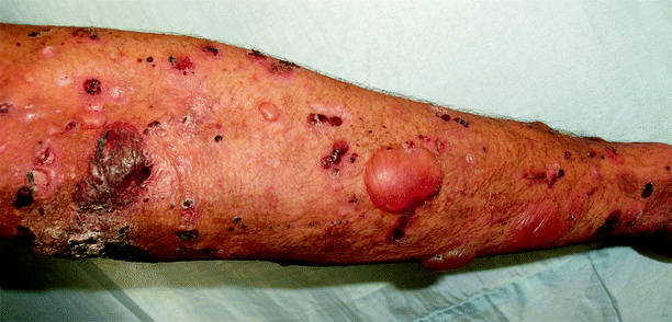 An Adult with Blisters and Milia on Trauma-Prone Sites