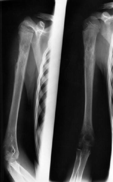 Osteochondroma-Related Pressure Erosions in Bony Rings Below the Waist