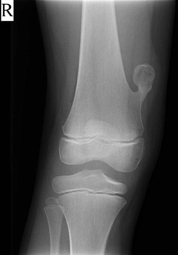 Osteochondroma-Related Pressure Erosions in Bony Rings Below the Waist