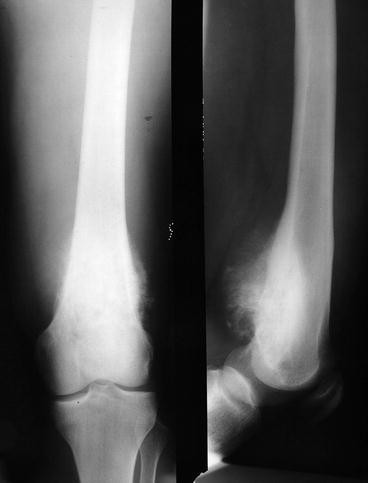 Osteochondroma-Related Pressure Erosions in Bony Rings Below the Waist