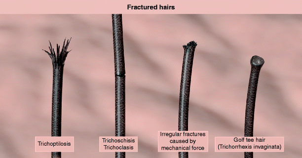 Hair Shafts | SpringerLink