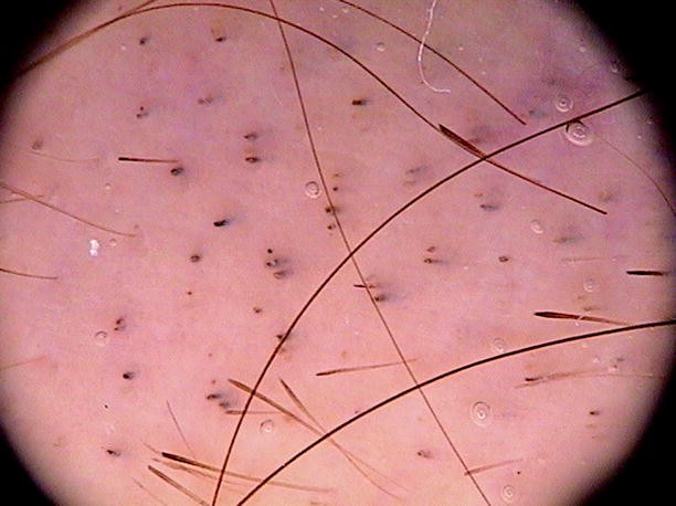 Hair Follicle Openings: Dots | SpringerLink Hair Follicle Openings: Dots | SpringerLink
