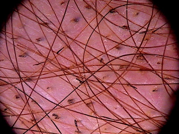 Hair Follicle Openings: Dots | SpringerLink Hair Follicle Openings: Dots | SpringerLink
