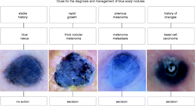 Benign Melanocytic Tumors | SpringerLink