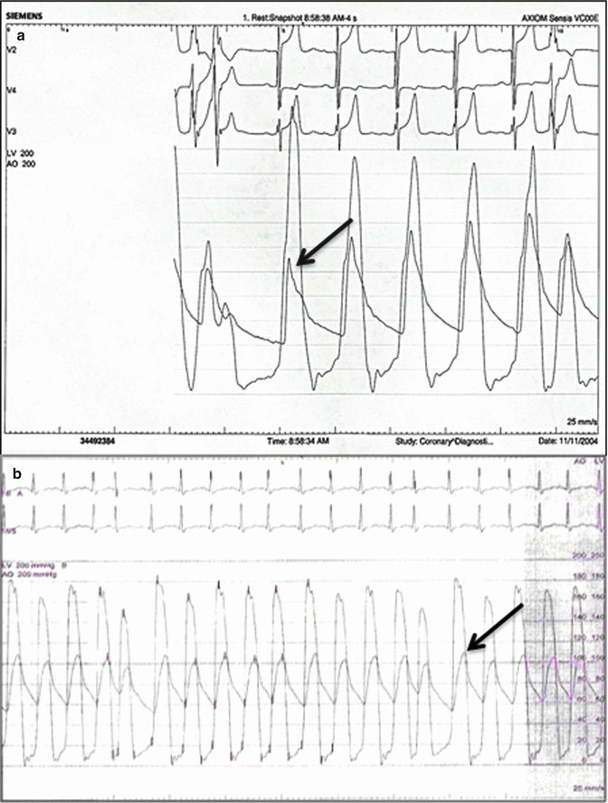 Invasive Evaluation of Aortic Stenosis | SpringerLink