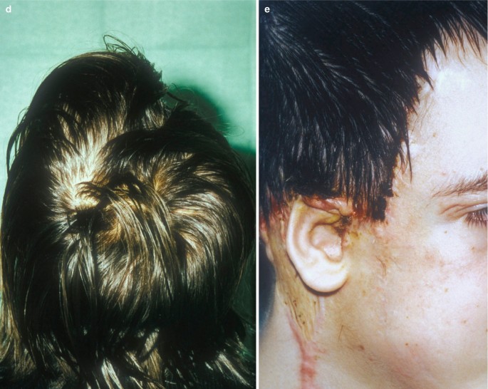 Hair Loss and Transplantation | SpringerLink