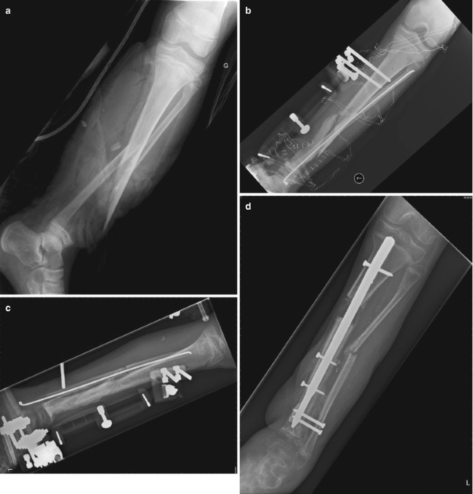 NuVasive's Precice Limb Lengthening System Is Now an Option for Pediatric  Patients - Xtalks