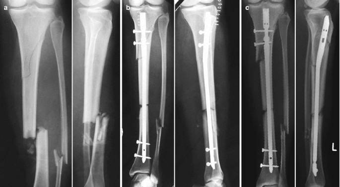 PDF] Elastic stable intramedullary nailing of femoral shaft fractures in  children. | Semantic Scholar