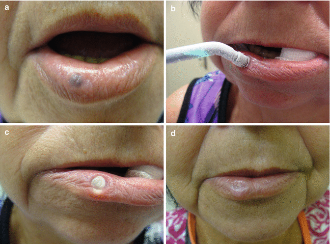labial melanotic macule cryotherapy Cheilitis and Miscellaneous Benign Lip Lesions