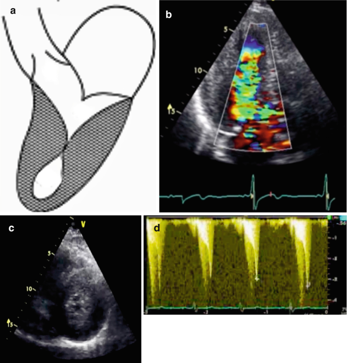 Apical Aneurysms and Mid–Left Ventricular Obstruction in Hypertrophic  Cardiomyopathy