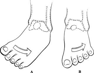 Ankle supination trauma