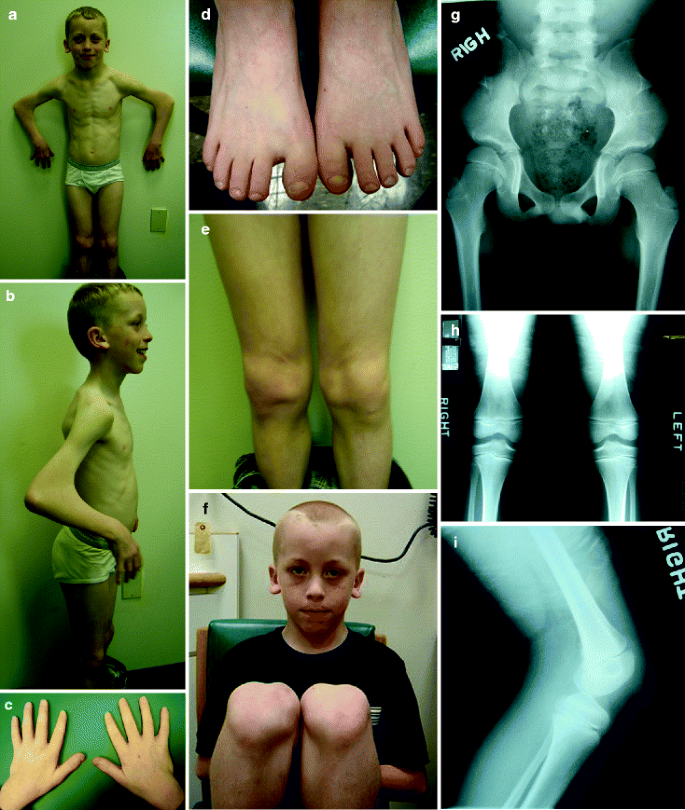 PDF) Nail-Patella Syndrome | Mayur Chaudhary - Academia.edu