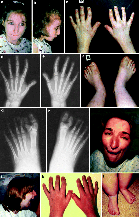 Two adults with Rubinstein–Taybi syndrome with mild mental retardation,  glaucoma, normal growth and skull circumference, and camptodactyly of third  fingers - Wieczorek - 2009 - American Journal of Medical Genetics Part A 