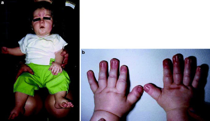 Figure 2. [Broad terminal phalanges (A) and broad, radially deviated thumbs  (B)]. - GeneReviews® - NCBI Bookshelf