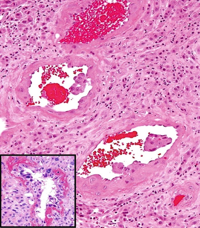Placental Site Nodule (PSN): An Uncommon Diagnosis with a Common